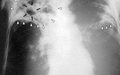 16 ciekawostek o gruźlicy