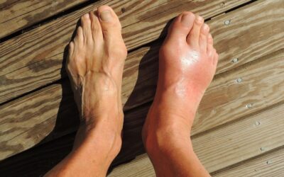 16 ciekawostek o artretyzmie