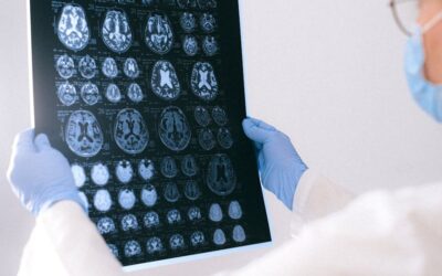 20 ciekawostek o udarze mózgu